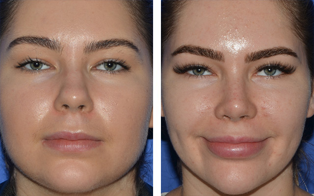 Buccal Fat Removal Before and After Beverly Hills