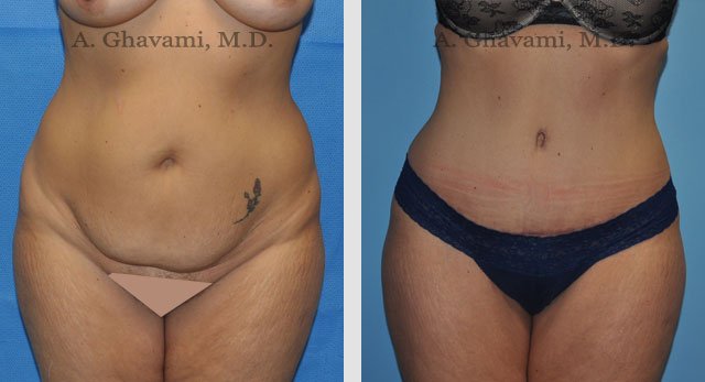 Tummy Tuck Beverly Hills - Abdominoplasty Los Angeles - Dr. Ghavami